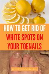 What are the best ways to get rid of there is more chance of an indoor cactus being infested with mealybugs than fungus. 7 Effective Home Remedies For White Spots On Toenails