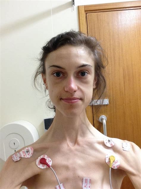 Anorexia Survivor Who Weighed Just 5st Shares Pictures Of Remarkable