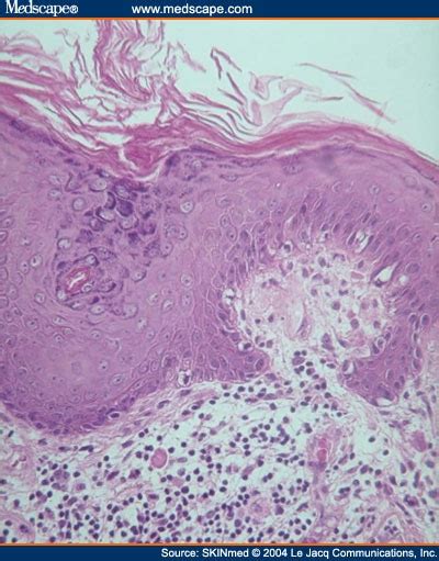 Cutaneous Hypertrophic Lupus Erythematosus