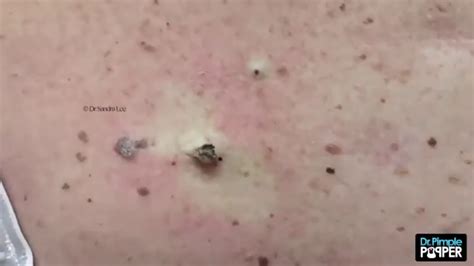 Dr Pimple Popper Deepest Blackhead You Have Ever Seen The Blast