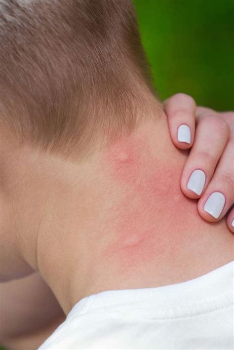9 Bug Bite Pictures How To Identify Common Types Of Bug Bites