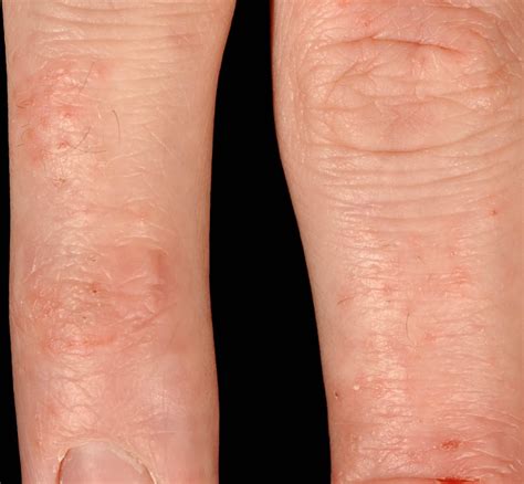 What Causes A Rash On Your Hands And Feet