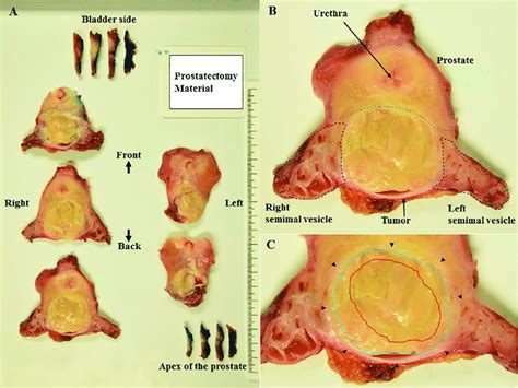 Gross Findings Of The Prostatectomy Specimen Cut Into Horizontal Download Scientific Diagram