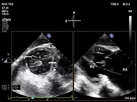 Transgastric X Plane View Of The Tricuspid Valve In Systole Right