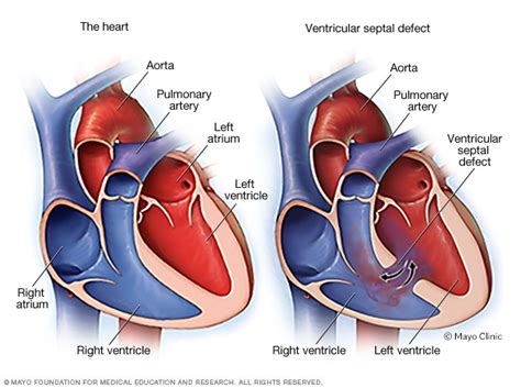 Ventricular Septal Defect VSD Symptoms And Causes Mayo Clinic