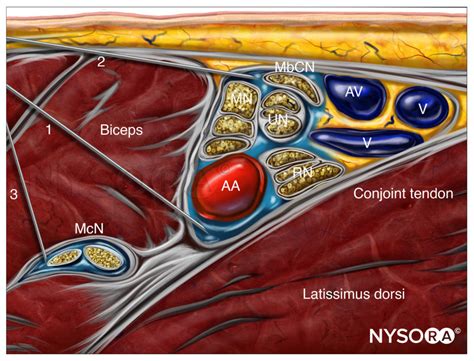 Axillary Brachial Plexus Block Chapter 9 Nysora Nysora