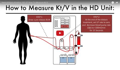 how to measure kt v hemodialysis kinetics 101 online calculator dialysis treatment the