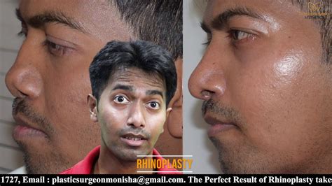 Lengthening Of Short Nose Rhinoplasty Nose Job Best Result After 4