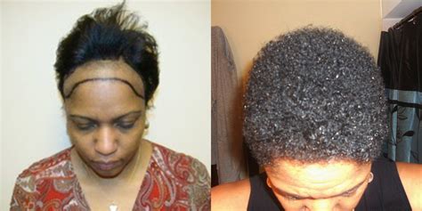 Hairline design for the african patient must also conform to ethnic specifications, namely in men a straighter, less curved shape, than what would be commonly observed in other races. hair transplant surgery for women in Fort Lauderdale ...