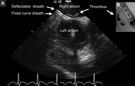 Right Atrial Thrombus Aspiration Guided By Intracardiac