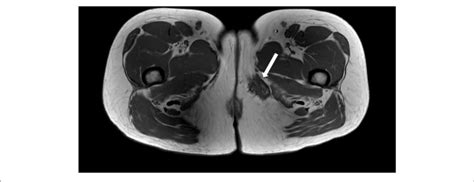 Axial T1 Weighted Mri Image Demonstrating A Spiculated Hypointense