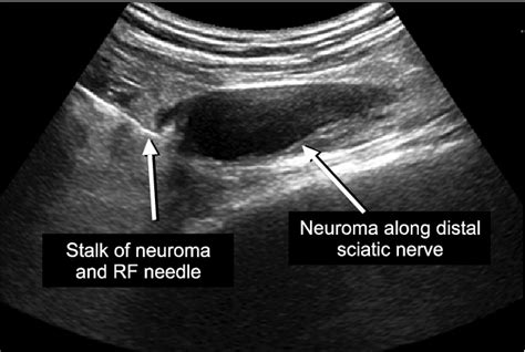 Image Of Pulsed Radiofrequency Ablation Under Ultrasound Guidance For