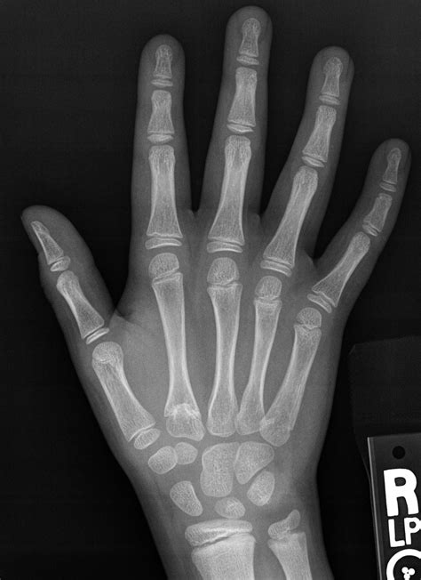 Hover on/off image to show/hide findings. File:X-ray of the hand of a 9 year old male - dorsoplantar ...