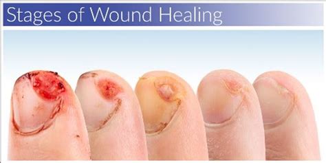 Wound Healing Content Tag
