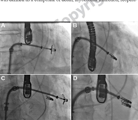 Figure 1 From Transcatheter Mitral Valve Interventions Current Status