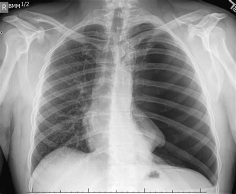 Chest Xray In Pneumothorax