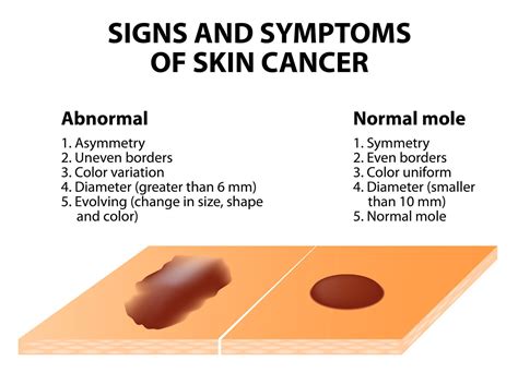 Skin Cancer Diagnosis And Treatment Options In Los Angeles California
