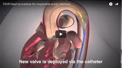 Tavr Procedure Video Mended Hearts