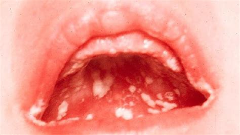 We did not find results for: Small Painful Lump On Lips | Ownerlip.co
