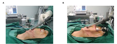 Figure From Transoral Endoscopic Thyroidectomy Via Submental And