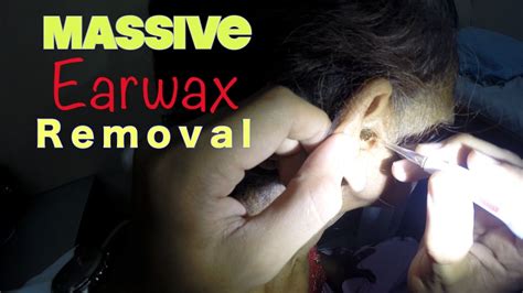 Massive Earwax Removal Youtube