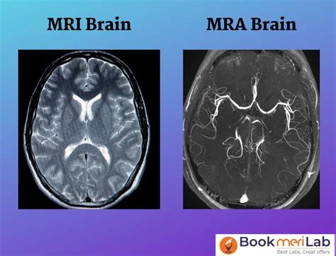 MRI Angiography Price Purpose Procedure Results 2023