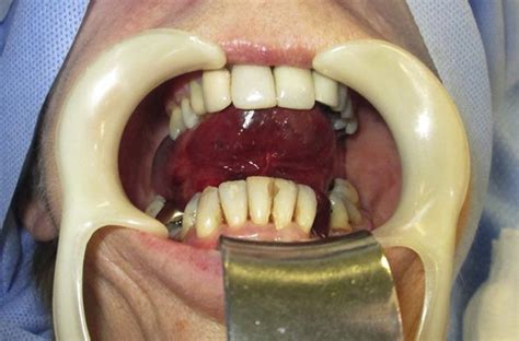 Floor Of Mouth Hematoma Following Dental Implant Placement Literature