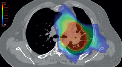 The Role Of Radiation Therapy In The Management Of Small Cell Lung