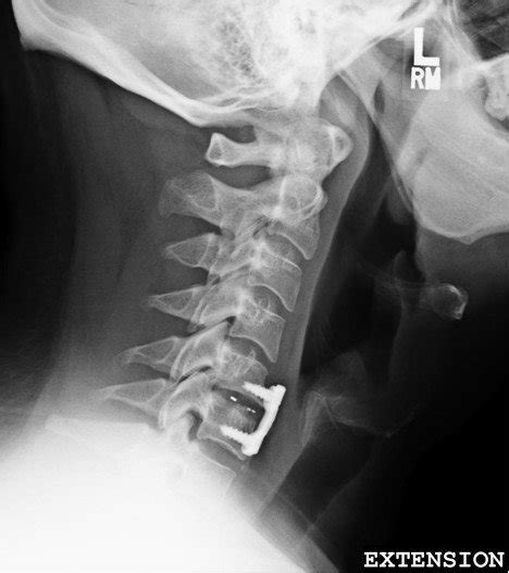 Postoperative Lateral Cervical X Ray Showing A Combined Anterior And