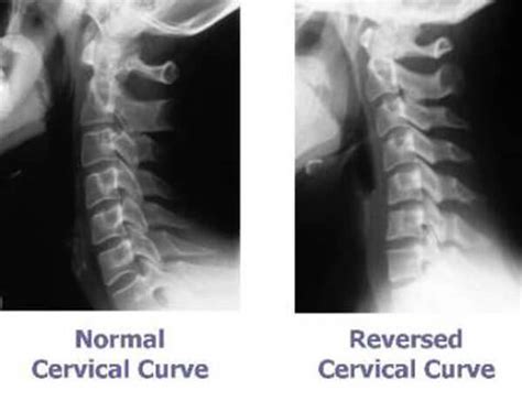 Pain In The Neck Advance Upper Cervical Chiropractic Walnut Creek