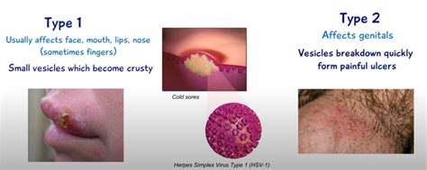 Mar 17, 2018 · the herpes simplex viruses are both similar and different and are often misunderstood. Difference Between HSV-1 and HSV-2? - Oral vs Genital Herpes