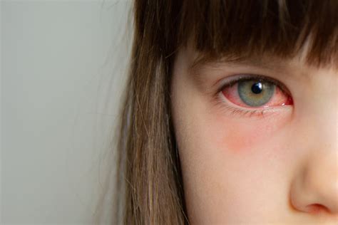 Home Remedies For Pink Eye Conjunctivitis
