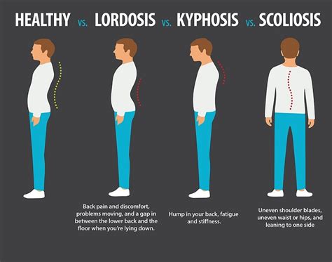 Lumbar Lordosis In Children Causes And Treatment Of Exercises