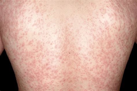Simple Rules To Follow Pityriasis Rosea Images