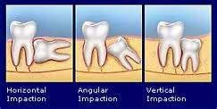 Persiapan medis hingga biaya operasi gigi bungsu penting untuk diketahui. Dunia Vitaminku: Cara hilangkan bengkak cabut gigi