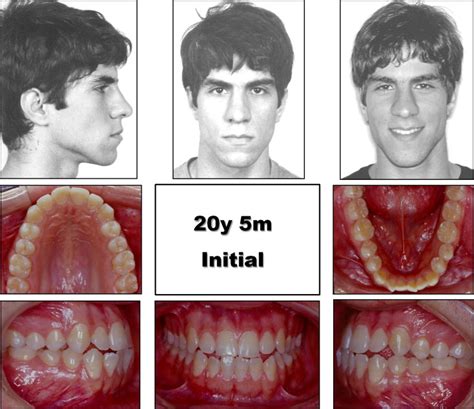 Class Iii Malocclusion Types