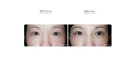 Lateral Canthoplasty Canthopexy Eyelid Surgery Wishclinic