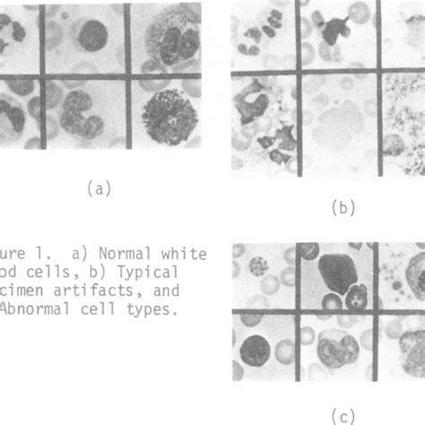 A Normal White Blood Cells B Typical Specimen Artifacts And C