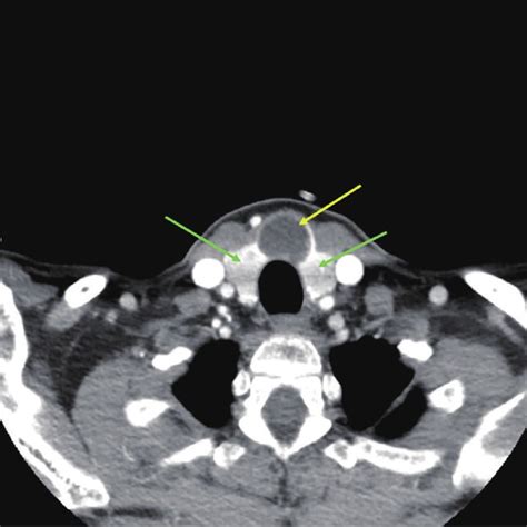 Pdf Thyroid Isthmusectomy For A Benign Nodule Of The Thyroid Isthmus