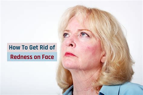How To Get Rid Of Redness On Face Naturally Natural Cure For Redness
