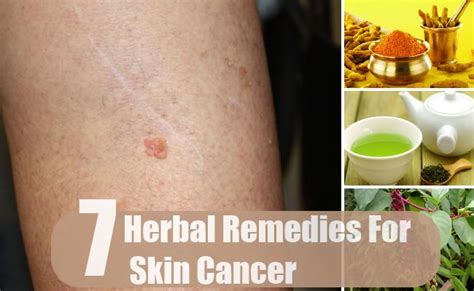 7 Amazing Herbal Remedies For Skin Cancer How To Treat
