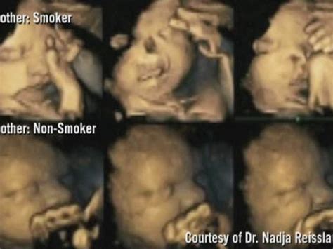 Suffering In The Womb Dramatic Pictures Show How Unborn Babies Of