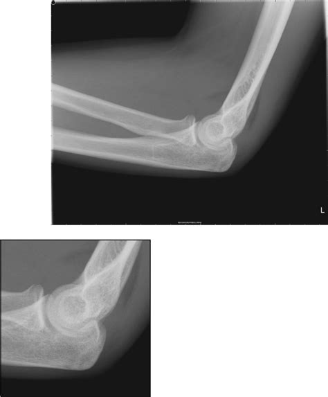 Image Diagnosis Radial Head Fracture The Permanente Journal