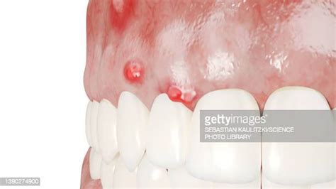 Abscess Illustration Photos And Premium High Res Pictures Getty Images