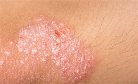 Comorbidities Associated With Pediatric Psoriasis Screening Guidelines