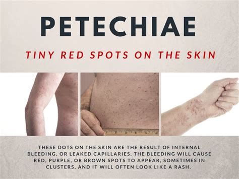 Tiny Red Spots On Skin Petechiae Causes And Treatments Dots Infos