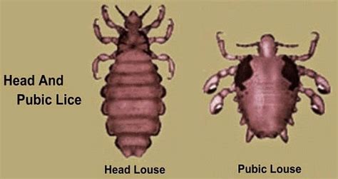 Head Lice Vs Pubic Lice Unraveling The Differences Bedbugs