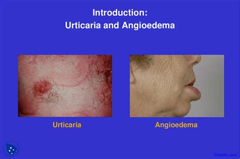 Urticaria And Angioedema Dermatology Lecture Slides Docsity