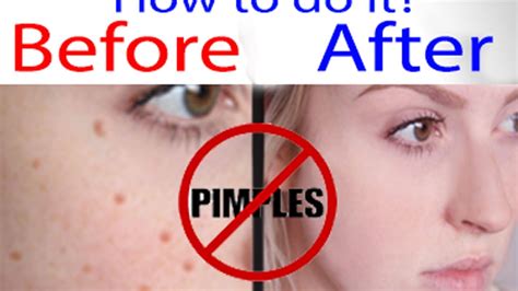 How To Remove Pimplesacne In 5 Minutes Tutorial For Beginners