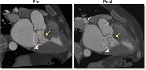Severe Mitral Annular Calcification Multimodality Imaging For